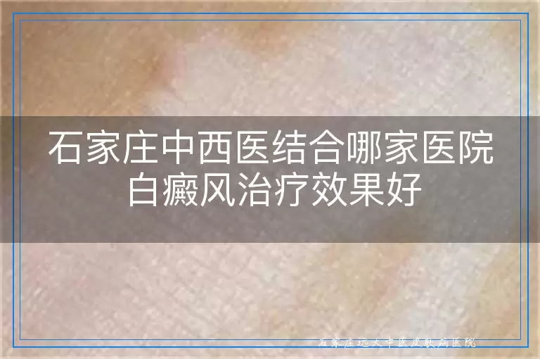 石家庄中西医结合哪家医院白癜风治疗效果好