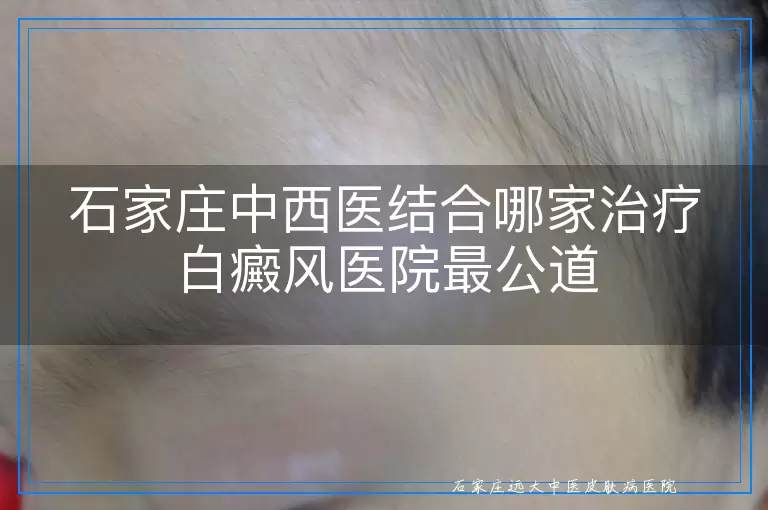 石家庄中西医结合哪家治疗白癜风医院最公道