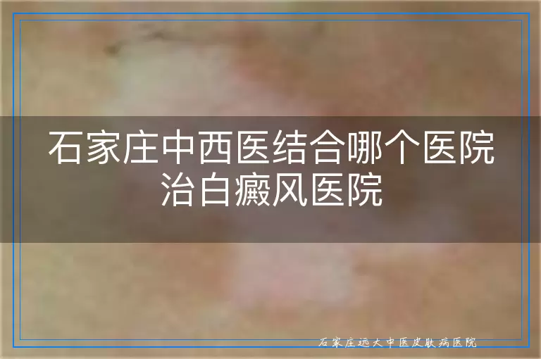 石家庄中西医结合哪个医院治白癜风医院
