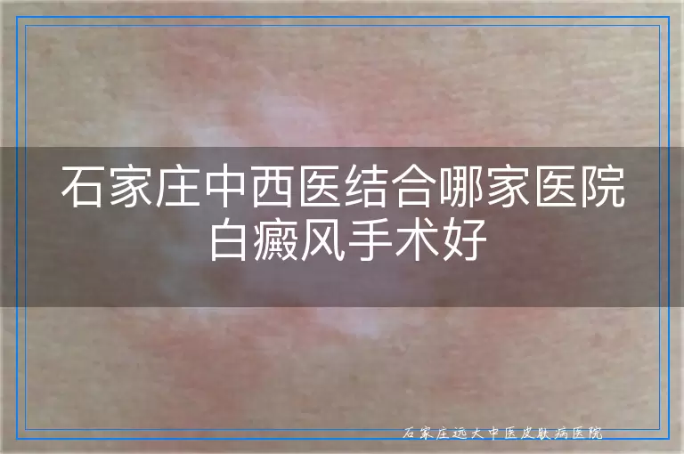 石家庄中西医结合哪家医院白癜风手术好