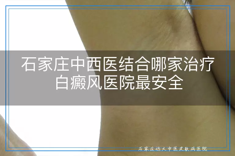 石家庄中西医结合哪家治疗白癜风医院最安全