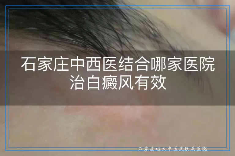 石家庄中西医结合哪家医院治白癜风有效