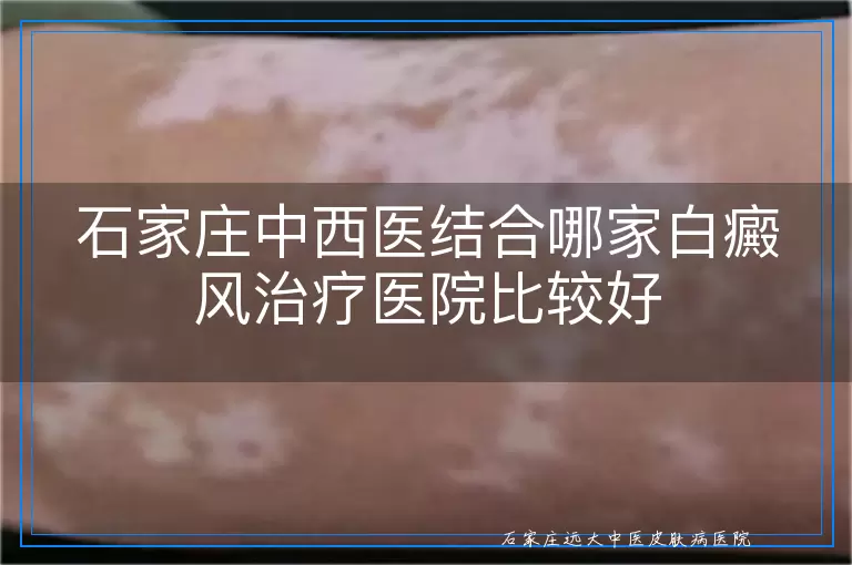 石家庄中西医结合哪家白癜风治疗医院比较好