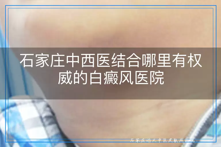 石家庄中西医结合哪里有权威的白癜风医院