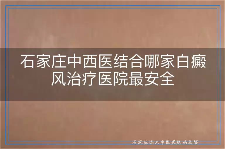 石家庄中西医结合哪家白癜风治疗医院最安全