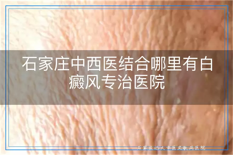 石家庄中西医结合哪里有白癜风专治医院