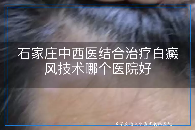 石家庄中西医结合治疗白癜风技术哪个医院好