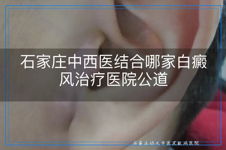 石家庄中西医结合哪家白癜风治疗医院公道