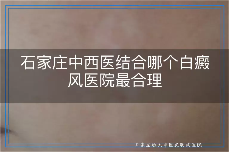 石家庄中西医结合哪个白癜风医院最合理
