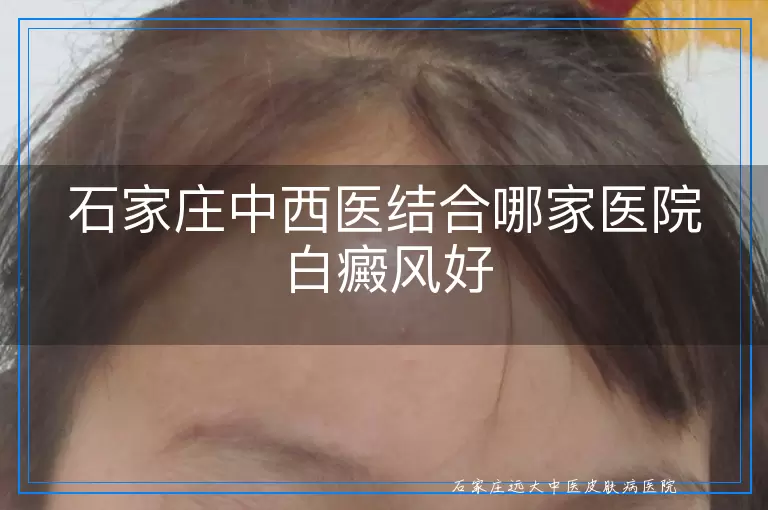 石家庄中西医结合哪家医院白癜风好