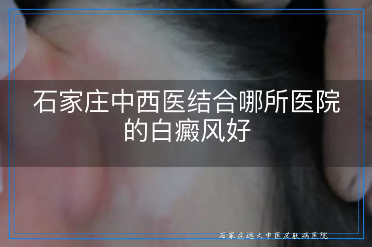 石家庄中西医结合哪所医院的白癜风好