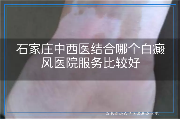 石家庄中西医结合哪个白癜风医院服务比较好