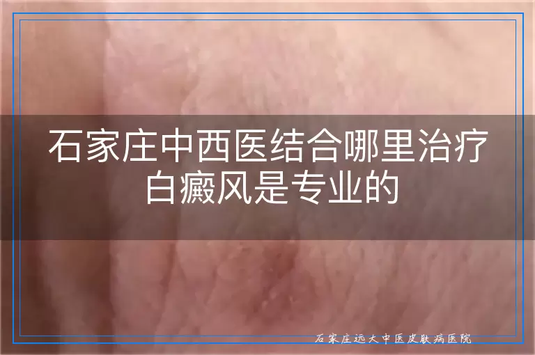 石家庄中西医结合哪里治疗白癜风是专业的