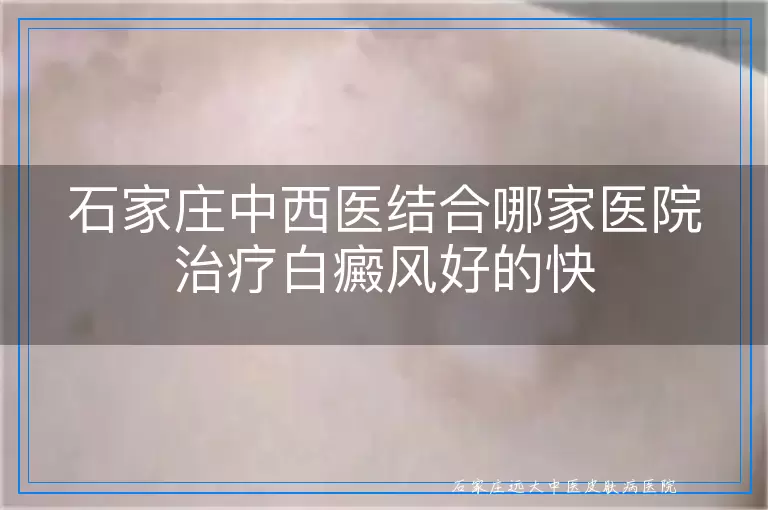 石家庄中西医结合哪家医院治疗白癜风好的快