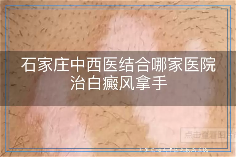 石家庄中西医结合哪家医院治白癜风拿手