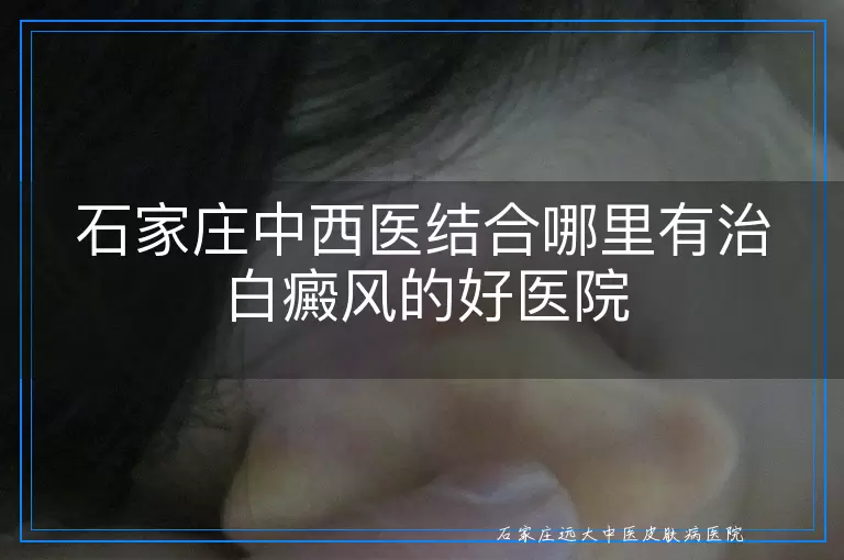 石家庄中西医结合哪里有治白癜风的好医院