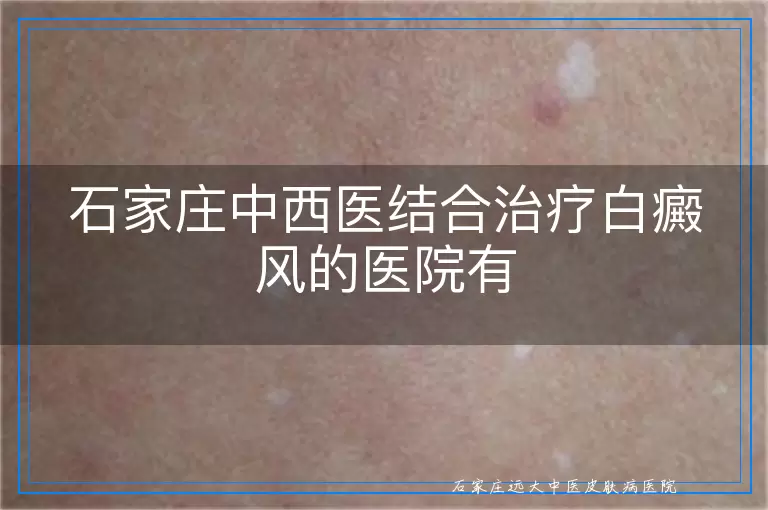 石家庄中西医结合治疗白癜风的医院有