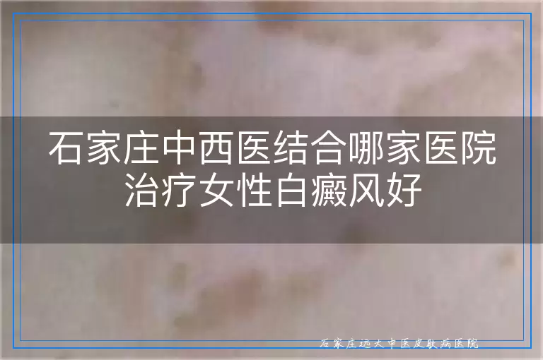 石家庄中西医结合哪家医院治疗女性白癜风好