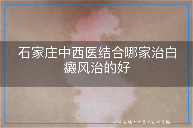石家庄中西医结合哪家治白癜风治的好