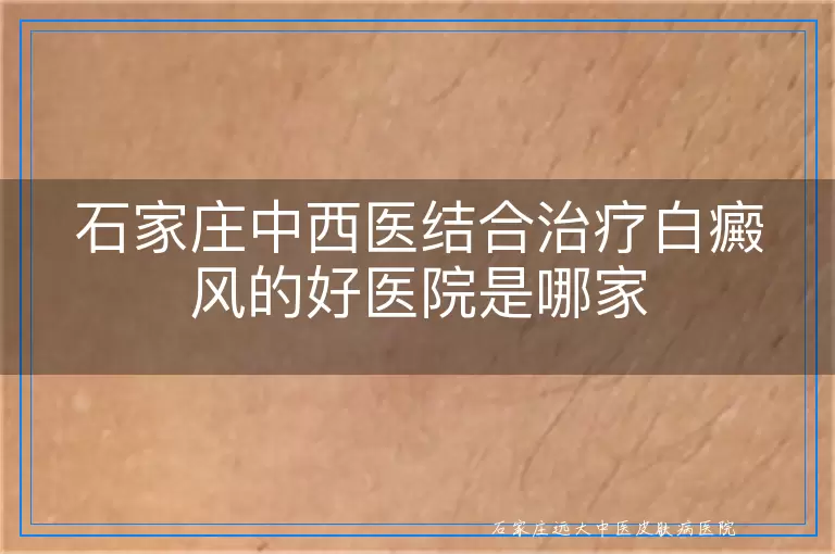 石家庄中西医结合治疗白癜风的好医院是哪家