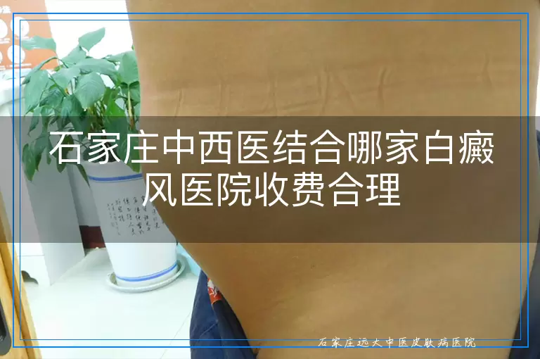 石家庄中西医结合哪家白癜风医院收费合理