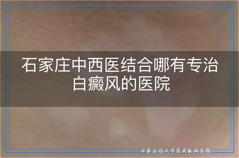 石家庄中西医结合哪有专治白癜风的医院