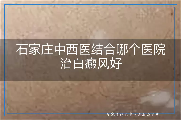 石家庄中西医结合哪个医院治白癜风好