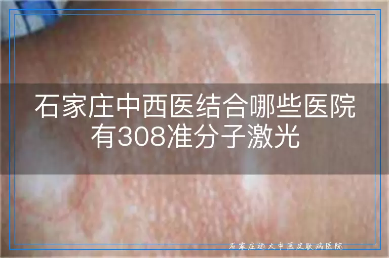 石家庄中西医结合哪些医院有308准分子激光