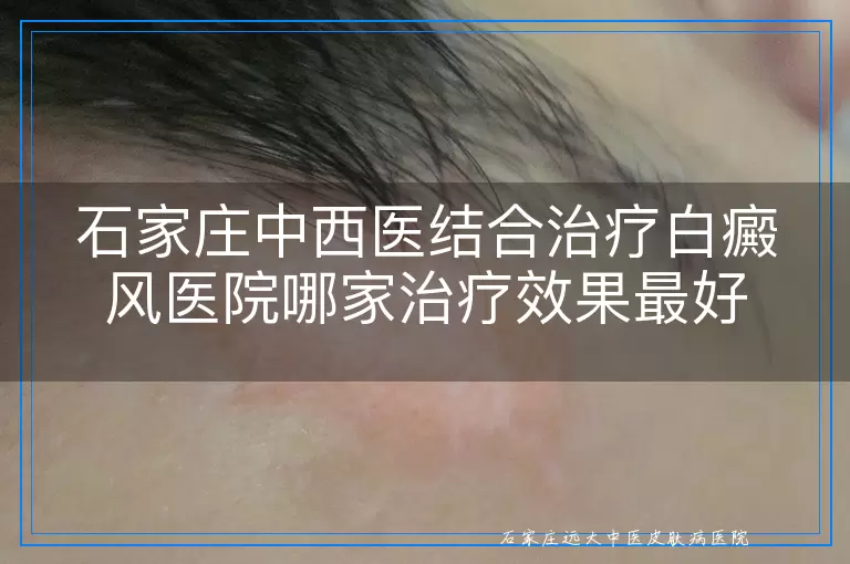 石家庄中西医结合治疗白癜风医院哪家治疗效果最好