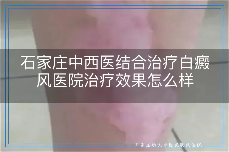 石家庄中西医结合治疗白癜风医院治疗效果怎么样
