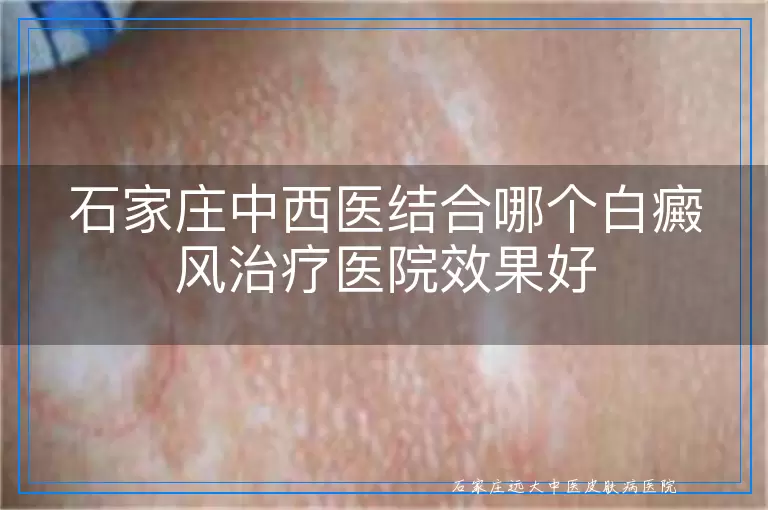 石家庄中西医结合哪个白癜风治疗医院效果好