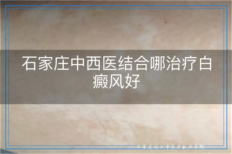 石家庄中西医结合哪治疗白癜风好