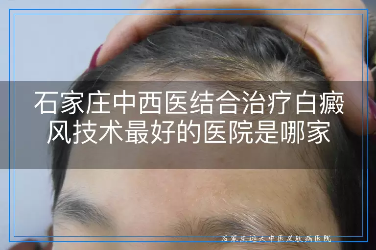 石家庄中西医结合治疗白癜风技术最好的医院是哪家