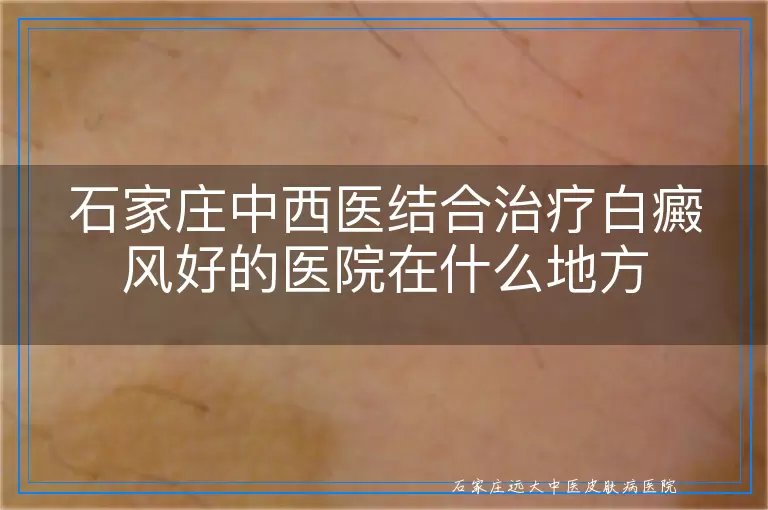 石家庄中西医结合治疗白癜风好的医院在什么地方