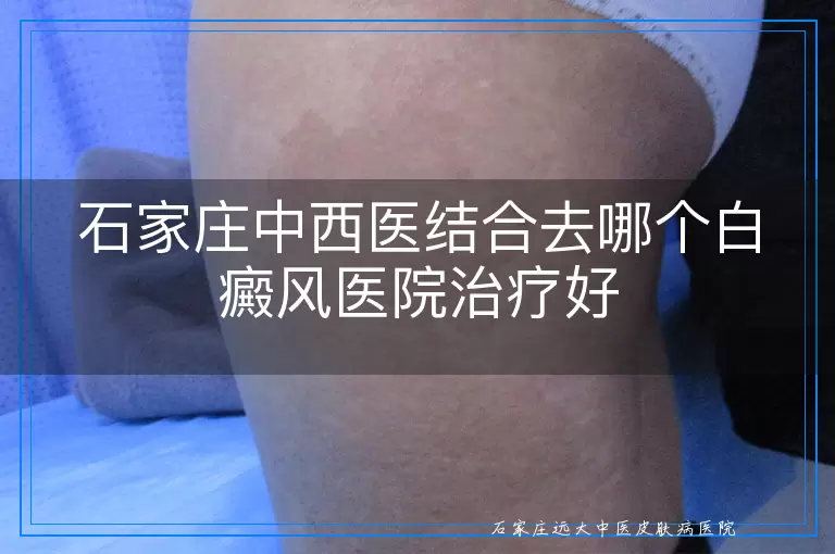 石家庄中西医结合去哪个白癜风医院治疗好