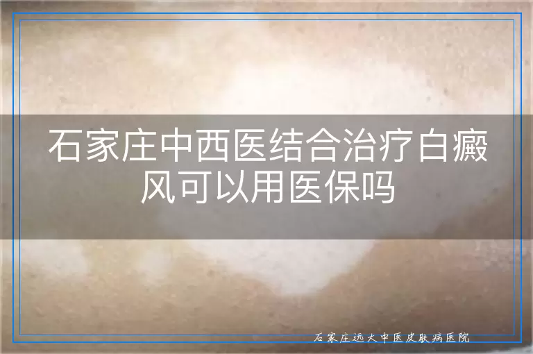石家庄中西医结合治疗白癜风可以用医保吗