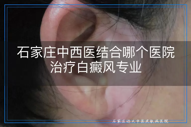 石家庄中西医结合哪个医院治疗白癜风专业