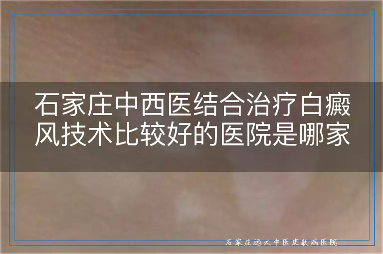 石家庄中西医结合治疗白癜风技术比较好的医院是哪家