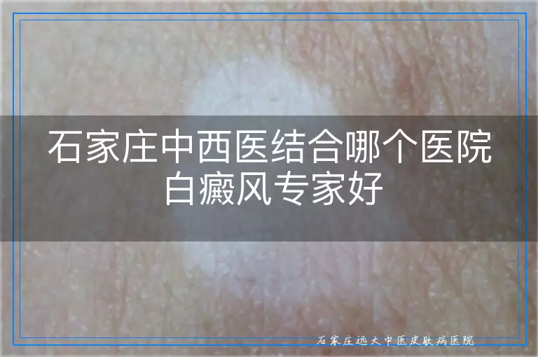 石家庄中西医结合哪个医院白癜风专家好