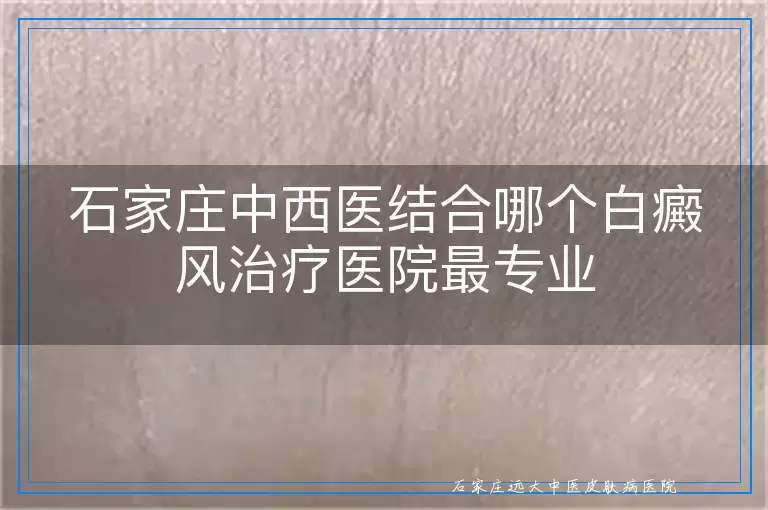 石家庄中西医结合哪个白癜风治疗医院最专业