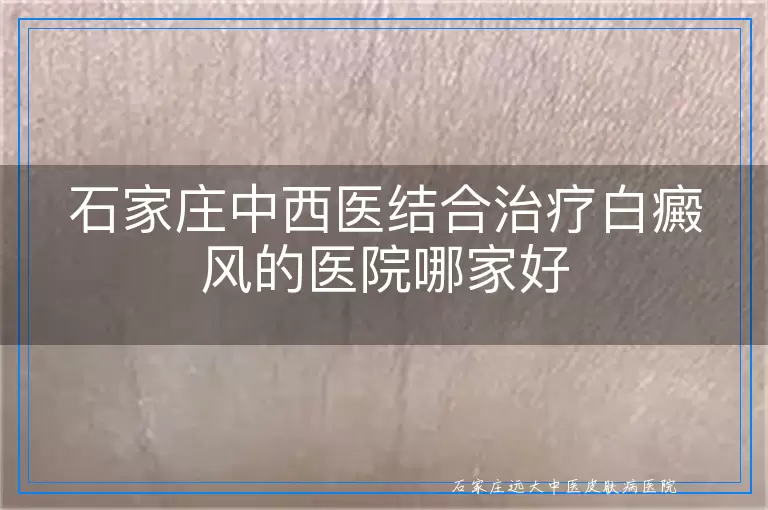 石家庄中西医结合治疗白癜风的医院哪家好