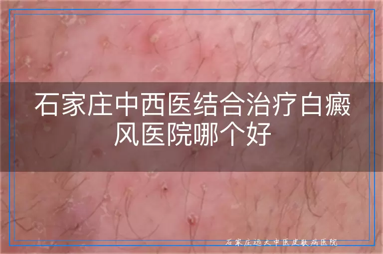 石家庄中西医结合治疗白癜风医院哪个好