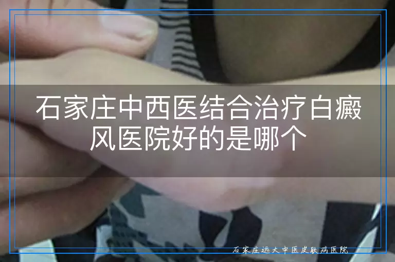 石家庄中西医结合治疗白癜风医院好的是哪个