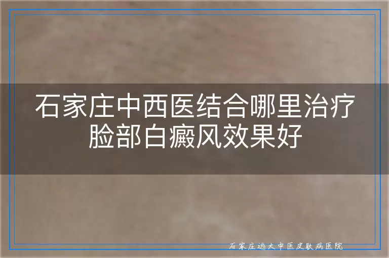 石家庄中西医结合哪里治疗脸部白癜风效果好