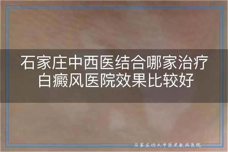 石家庄中西医结合哪家治疗白癜风医院效果比较好