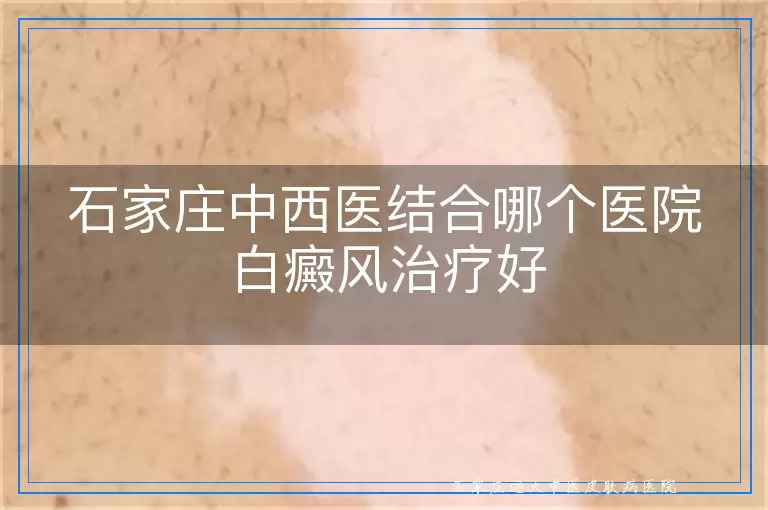 石家庄中西医结合哪个医院白癜风治疗好