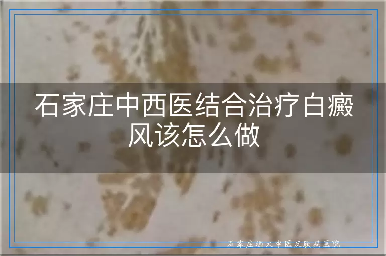 石家庄中西医结合治疗白癜风该怎么做