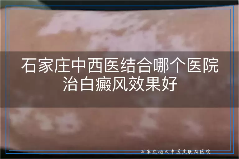 石家庄中西医结合哪个医院治白癜风效果好