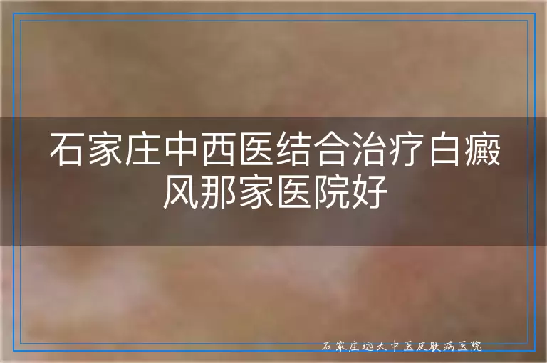 石家庄中西医结合治疗白癜风那家医院好