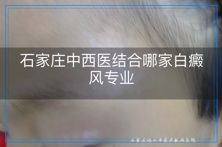 石家庄中西医结合哪家白癜风专业
